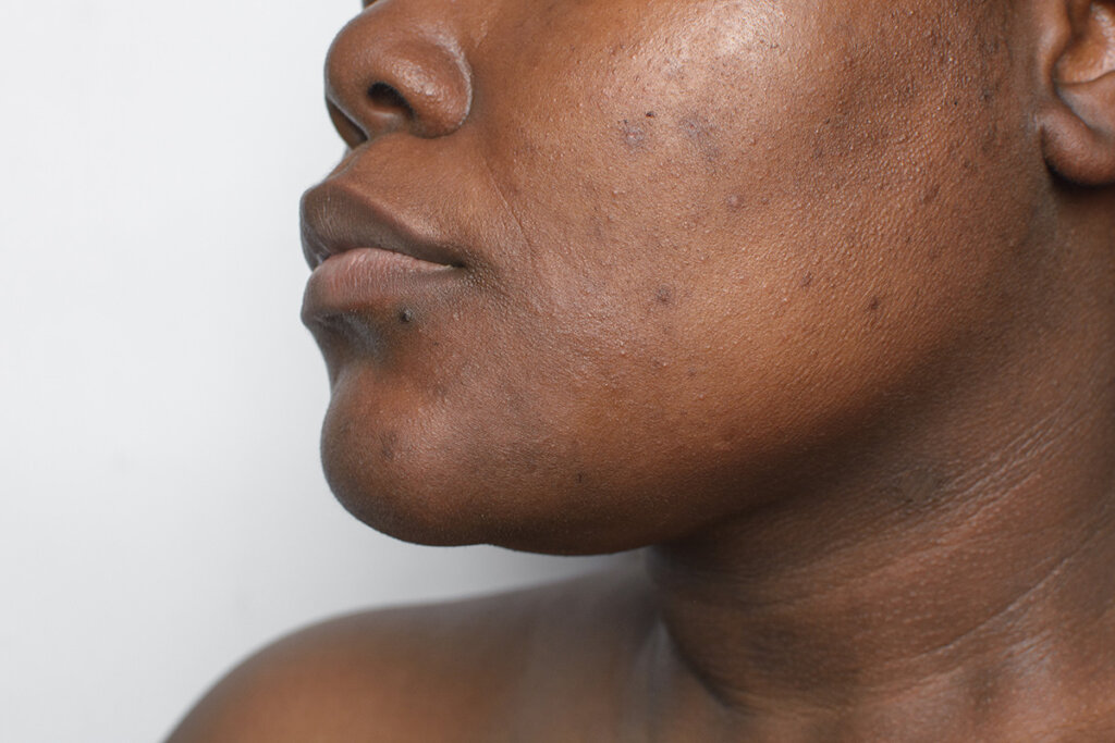 Dark Spots & Uneven Skintone